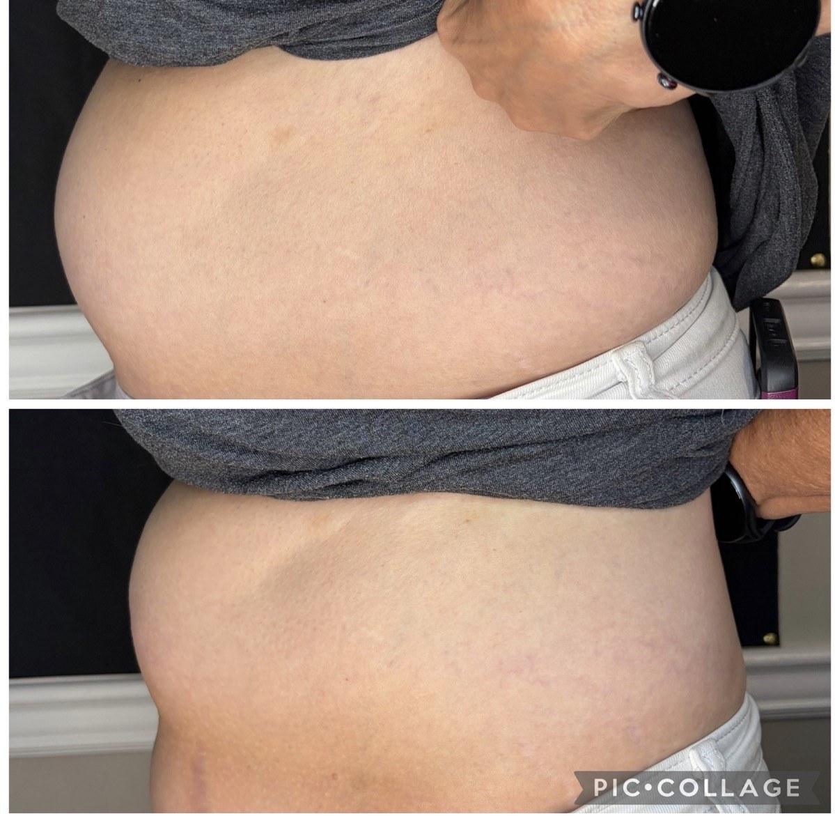 Abdominal Sculpting before and after result