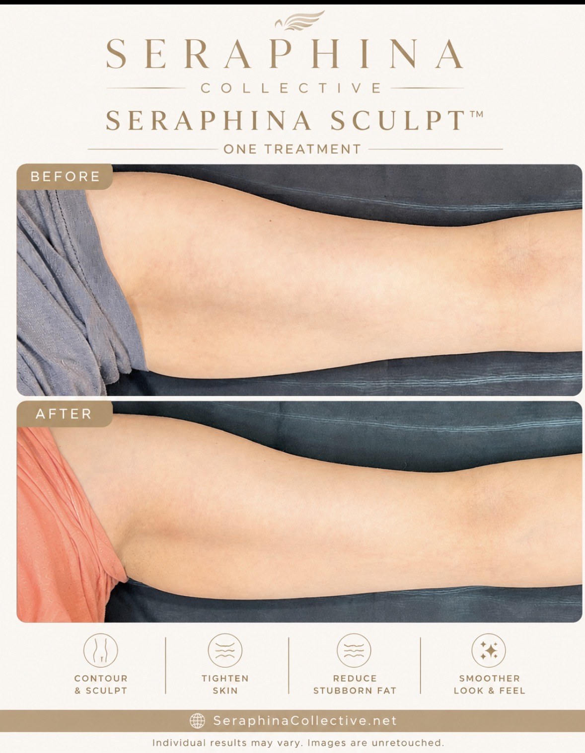 Body Sculpting — One Treatment before and after result