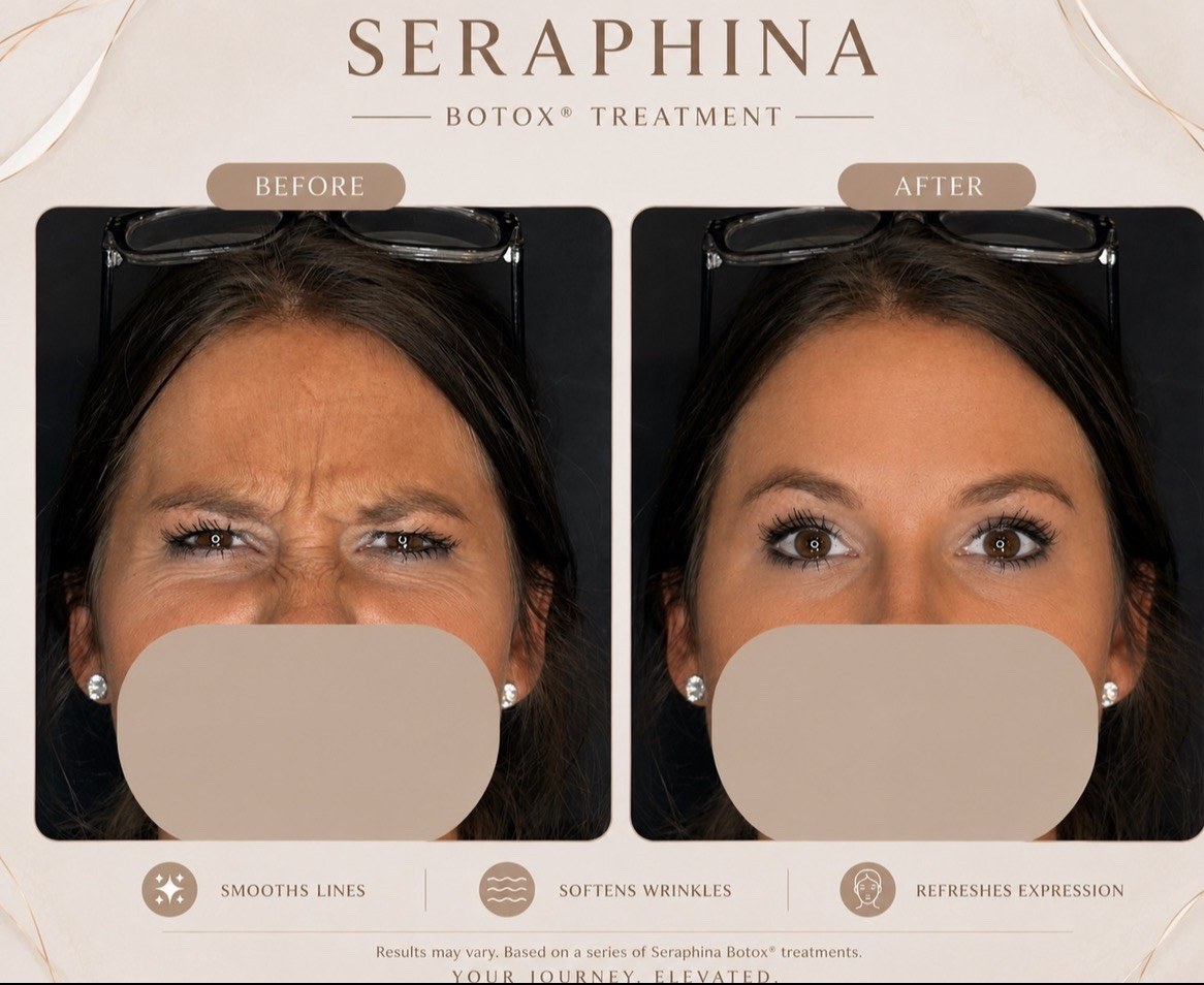 Botox Expression Lines before and after result