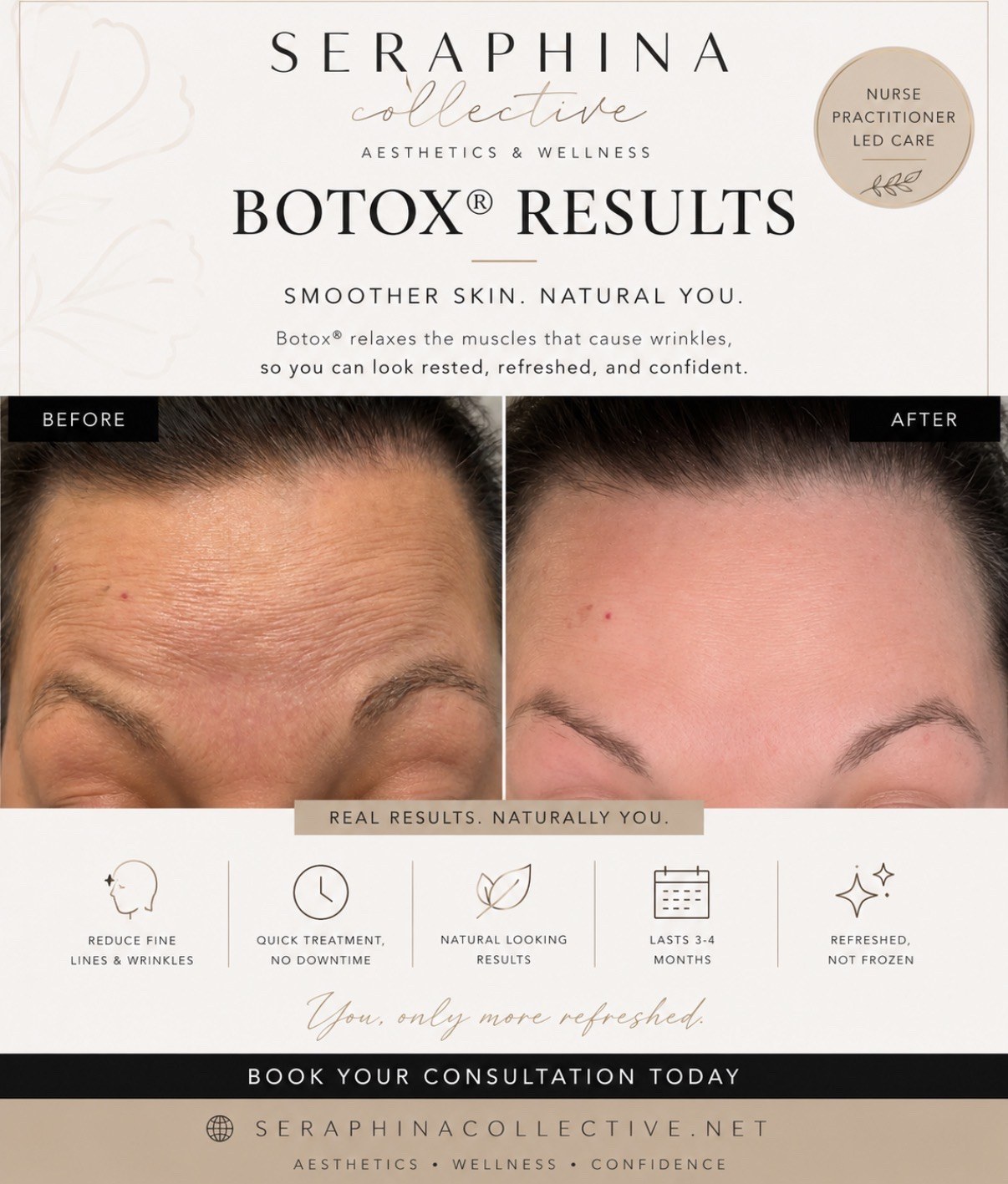 Botox Forehead Results before and after result
