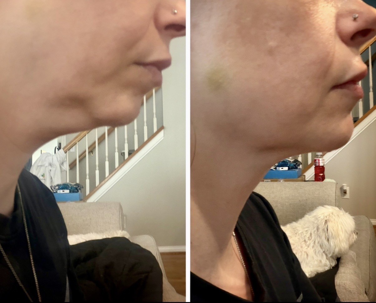 Jawline Rejuvenation before and after result