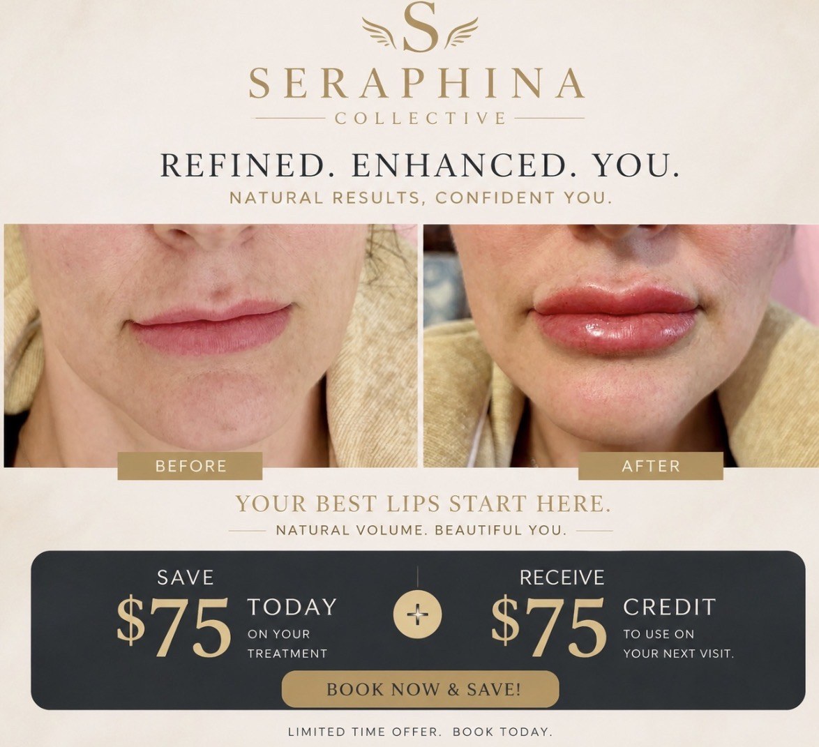 Lip Enhancement before and after result