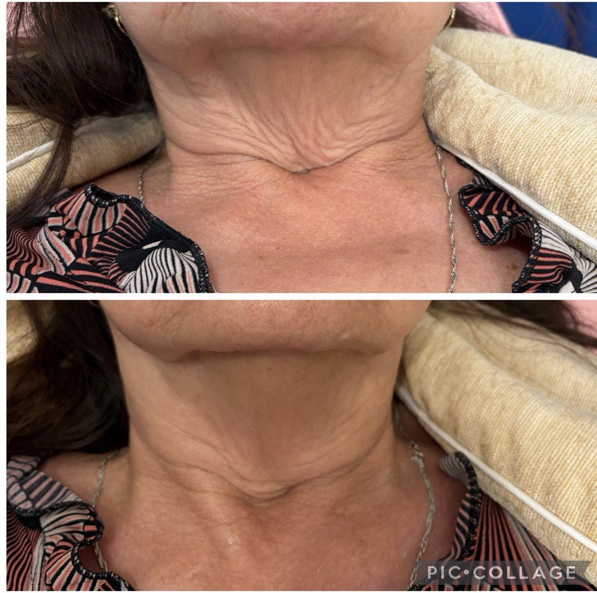 Neck Rejuvenation before and after result