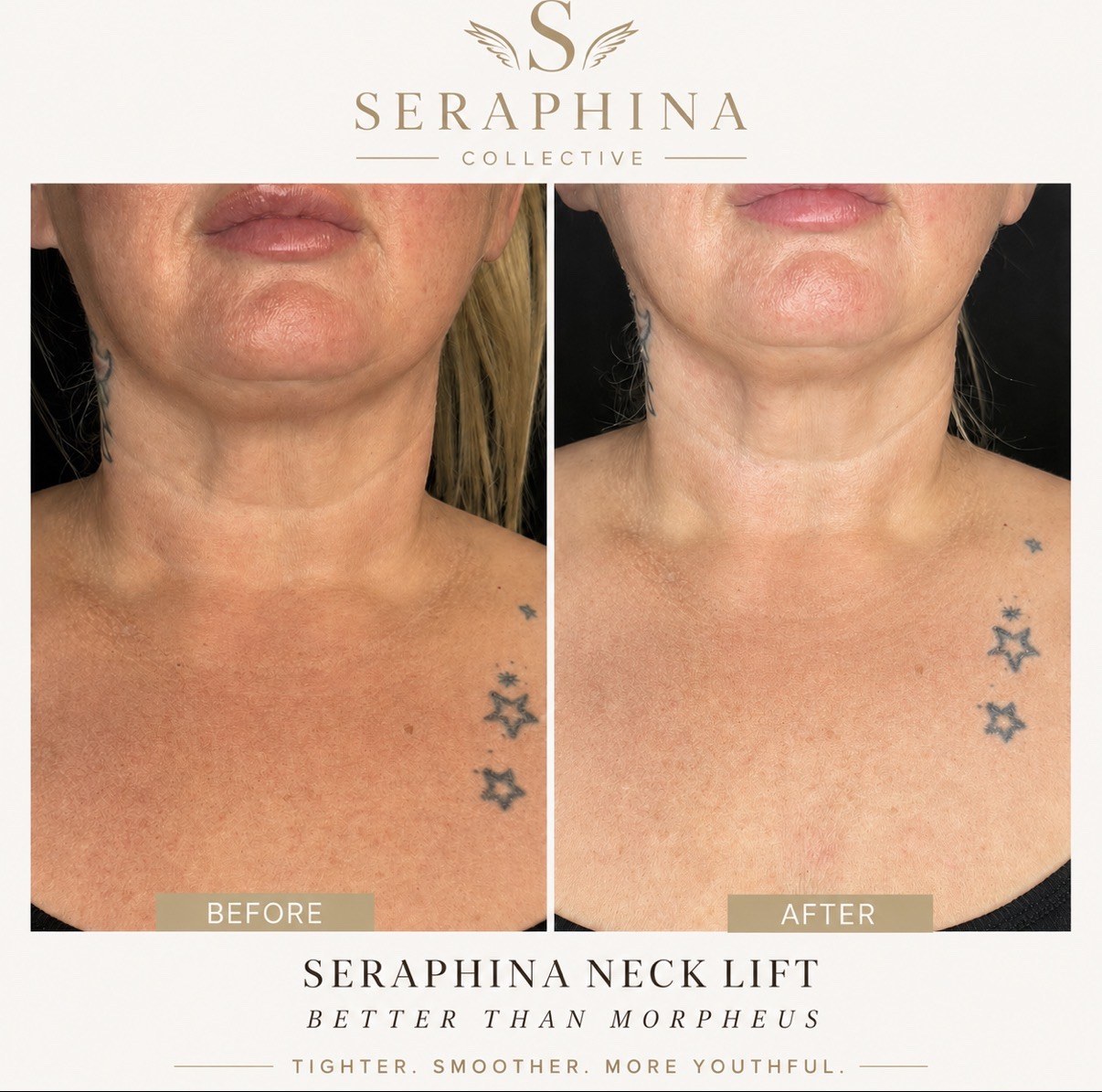 Seraphina Neck Lift before and after result