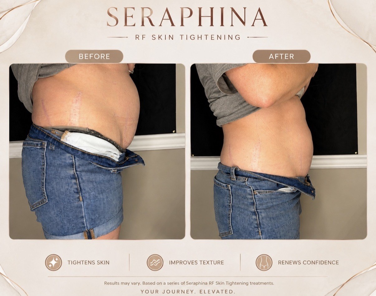 RF Skin Tightening before and after result